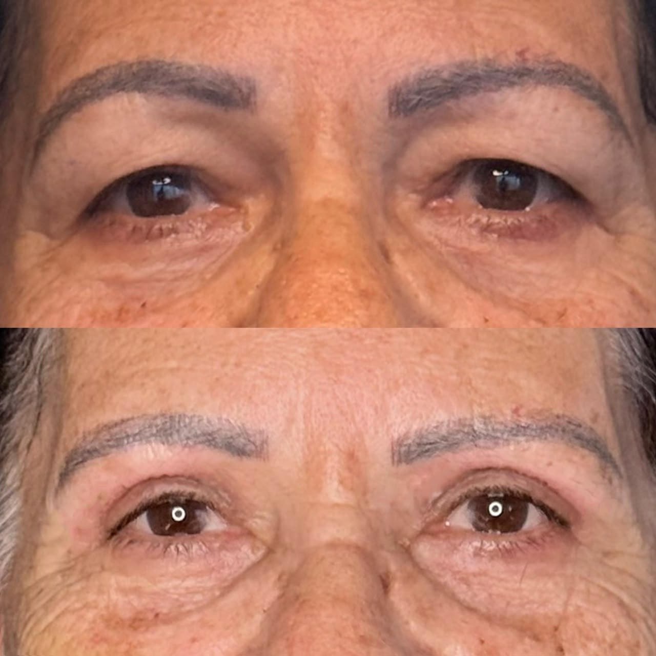 Comparativo de antes e depois de blefaroplastia, resultado 1