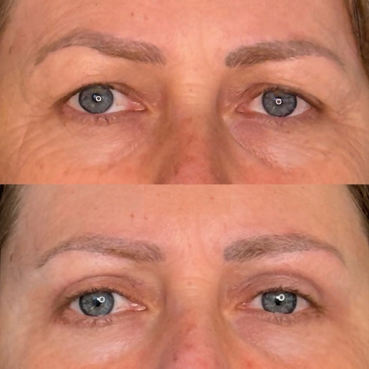Comparativo de antes e depois de blefaroplastia, resultado 2