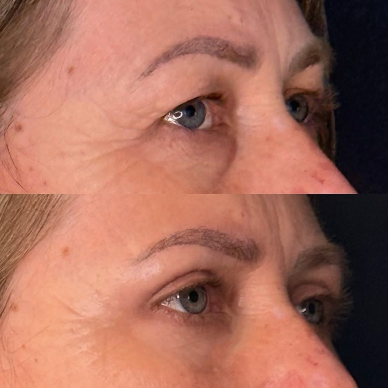 Comparativo de antes e depois de blefaroplastia, resultado 3