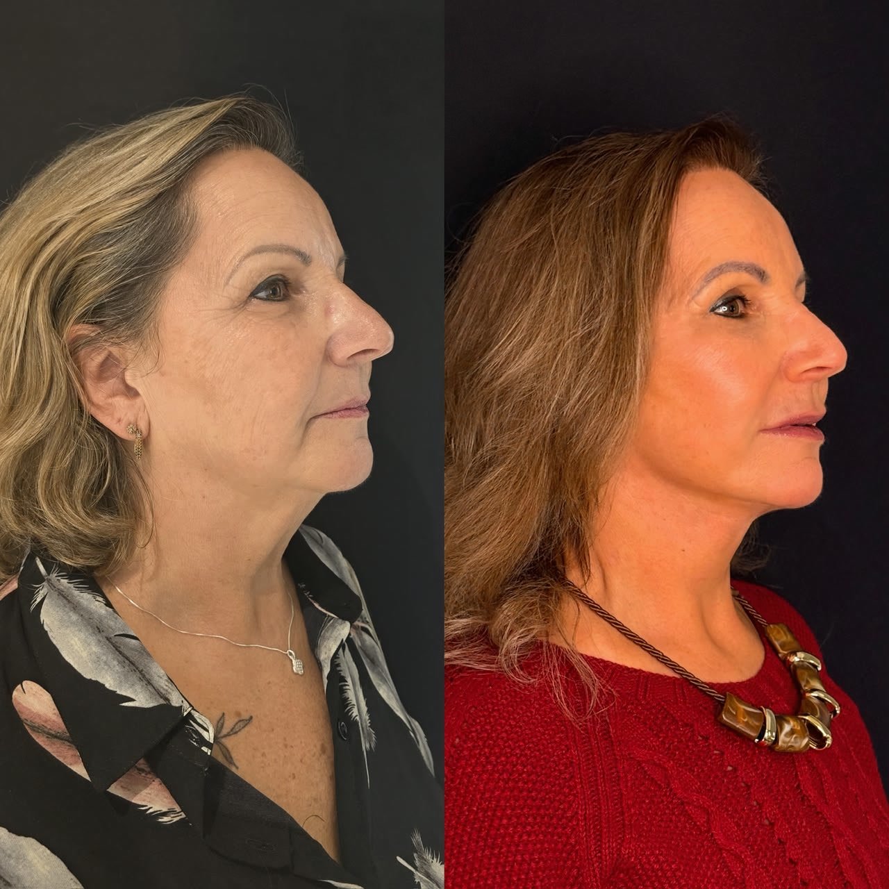 Comparativo de antes e depois de lifting facial, resultado 1