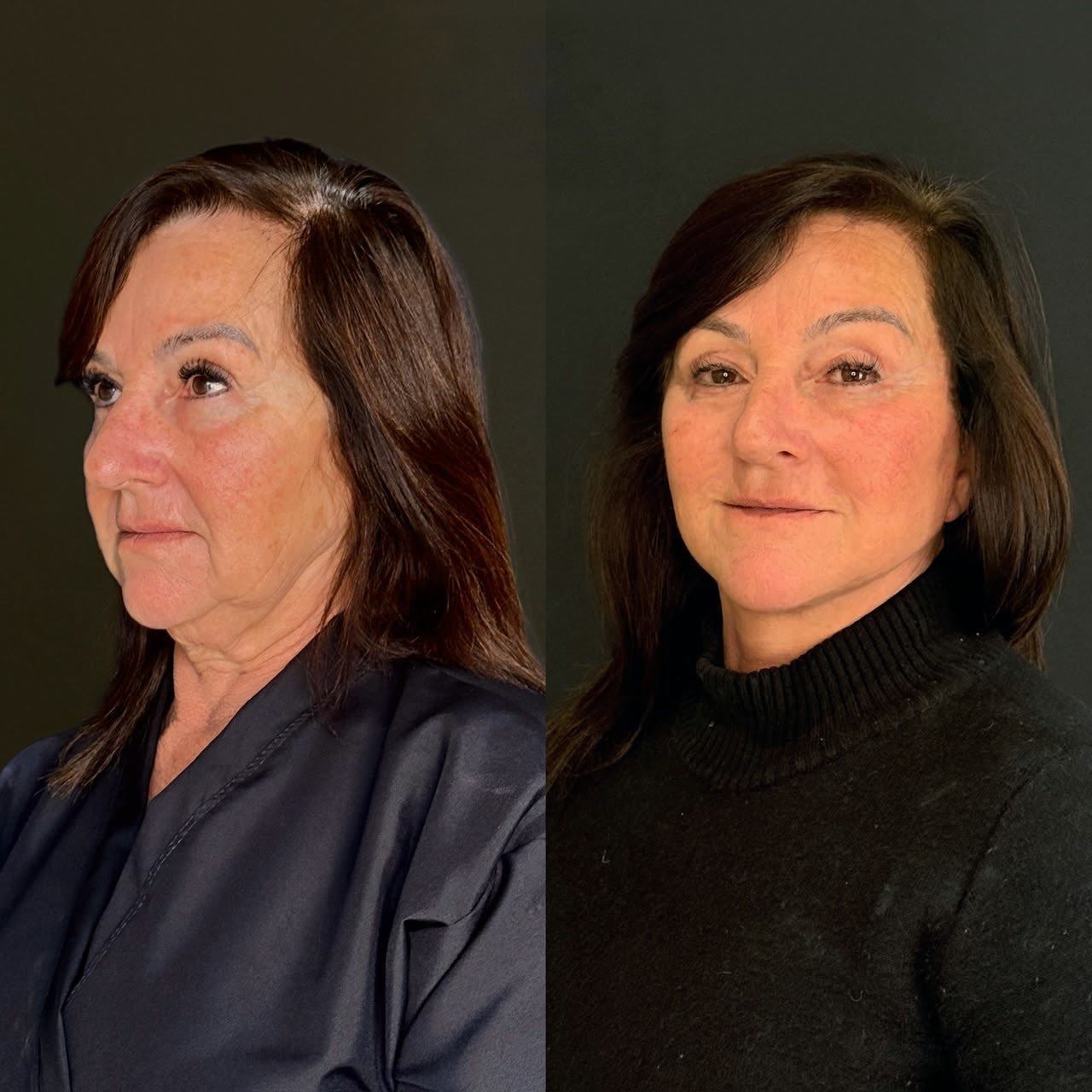 Comparativo de antes e depois de lifting facial, resultado 2