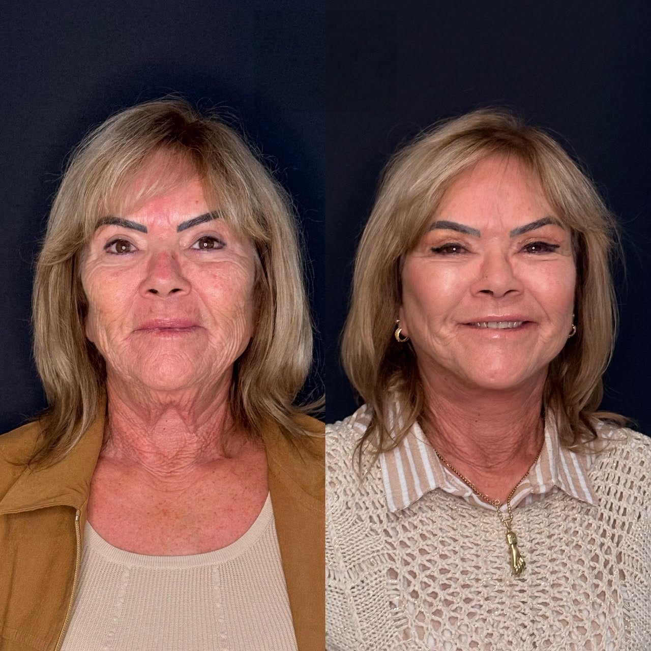 Comparativo de antes e depois de lifting facial, resultado 3
