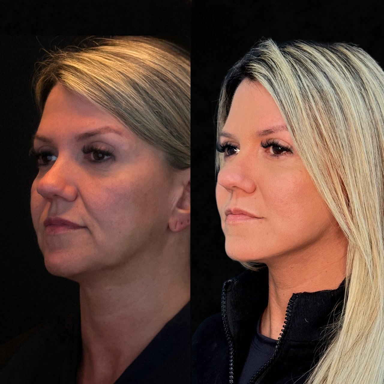 Comparativo de antes e depois de lifting facial, resultado 4