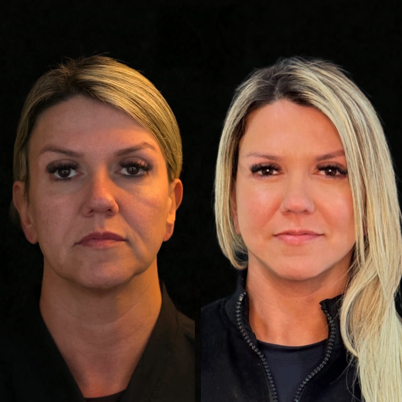 Comparativo de antes e depois de lifting facial, resultado 5