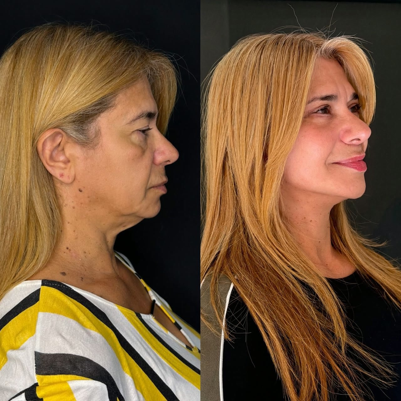 Comparativo de antes e depois de lifting facial, resultado 6