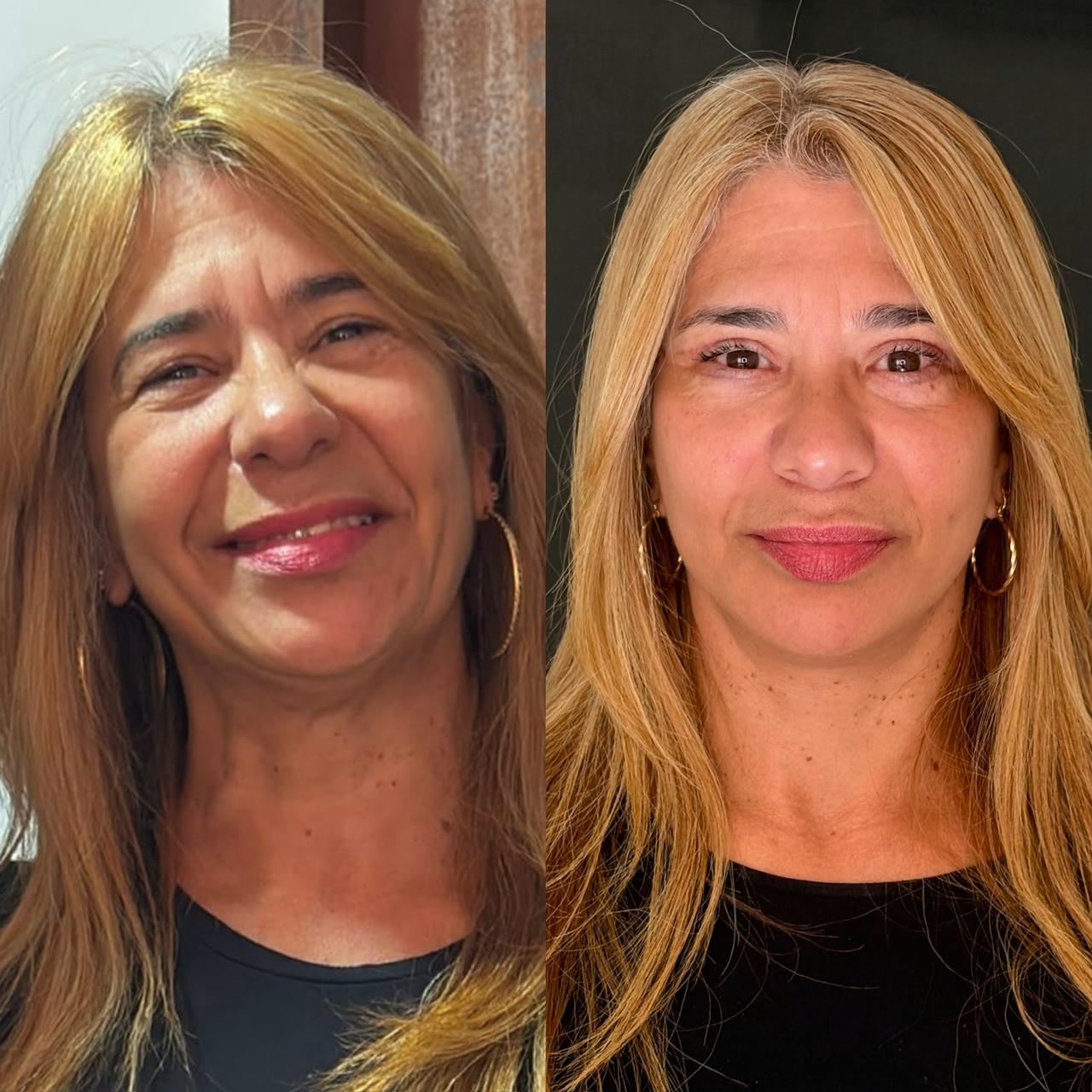 Comparativo de antes e depois de lifting facial, resultado 7