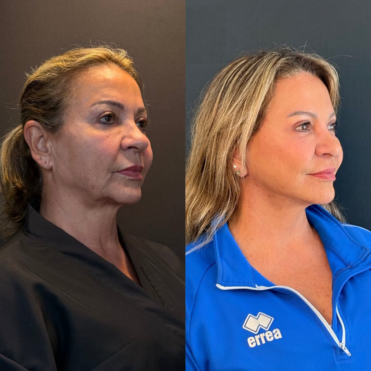 Comparativo de antes e depois de lifting facial, resultado 8