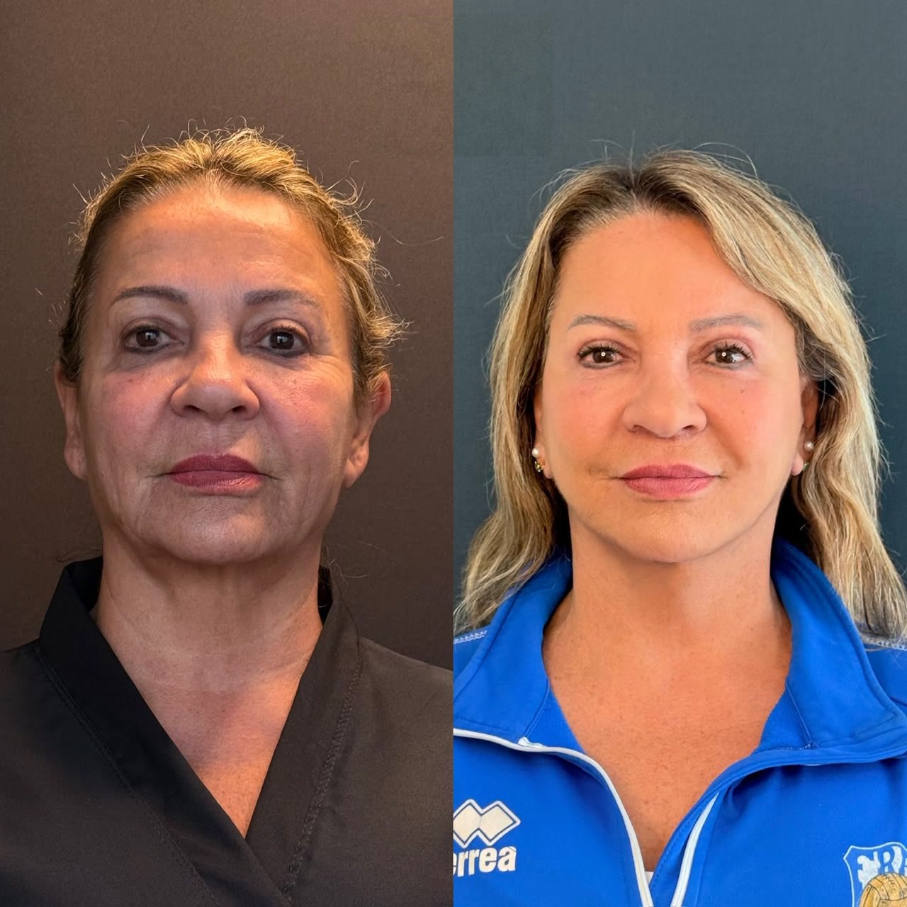 Comparativo de antes e depois de lifting facial, resultado 9