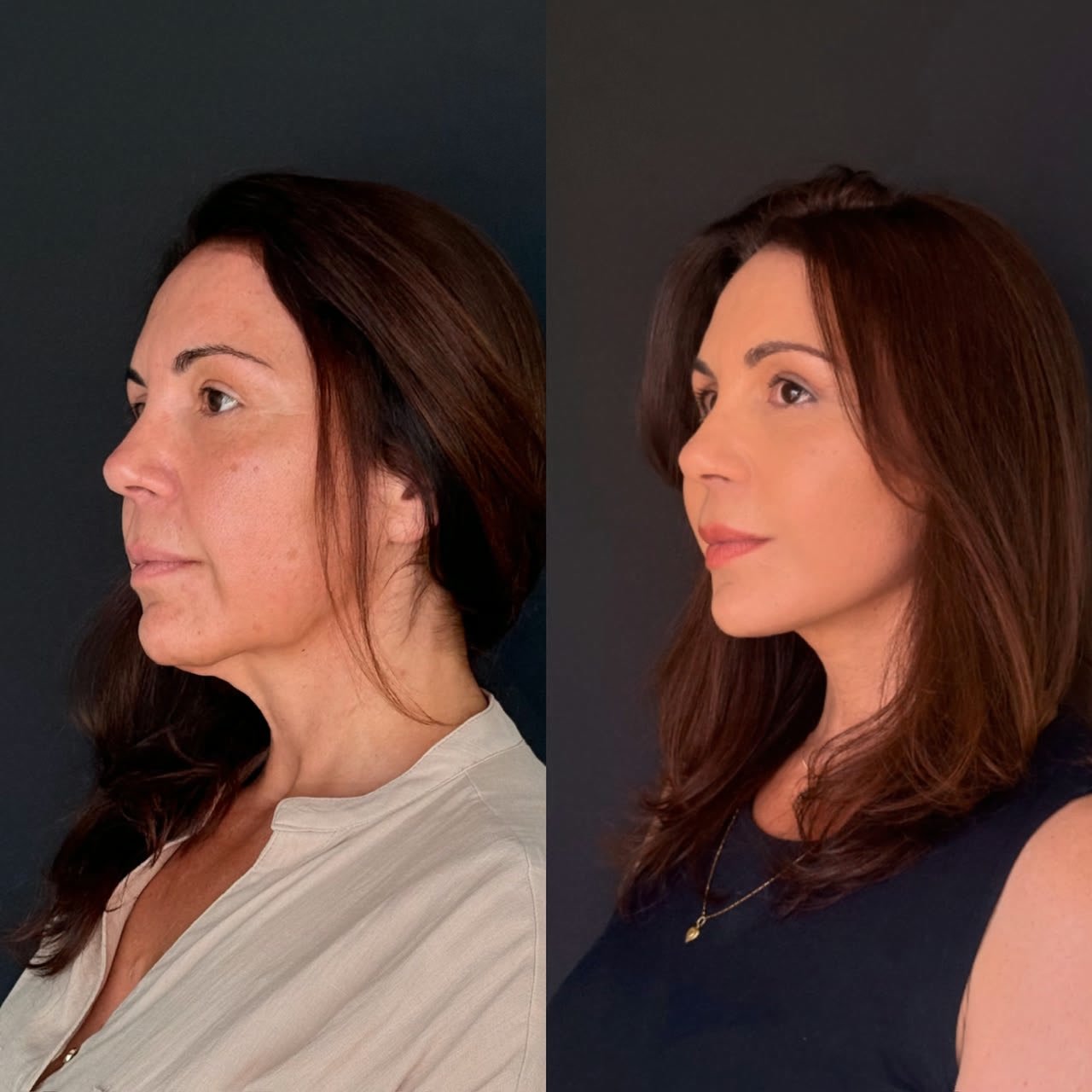 Comparativo de antes e depois de lifting facial, resultado 10