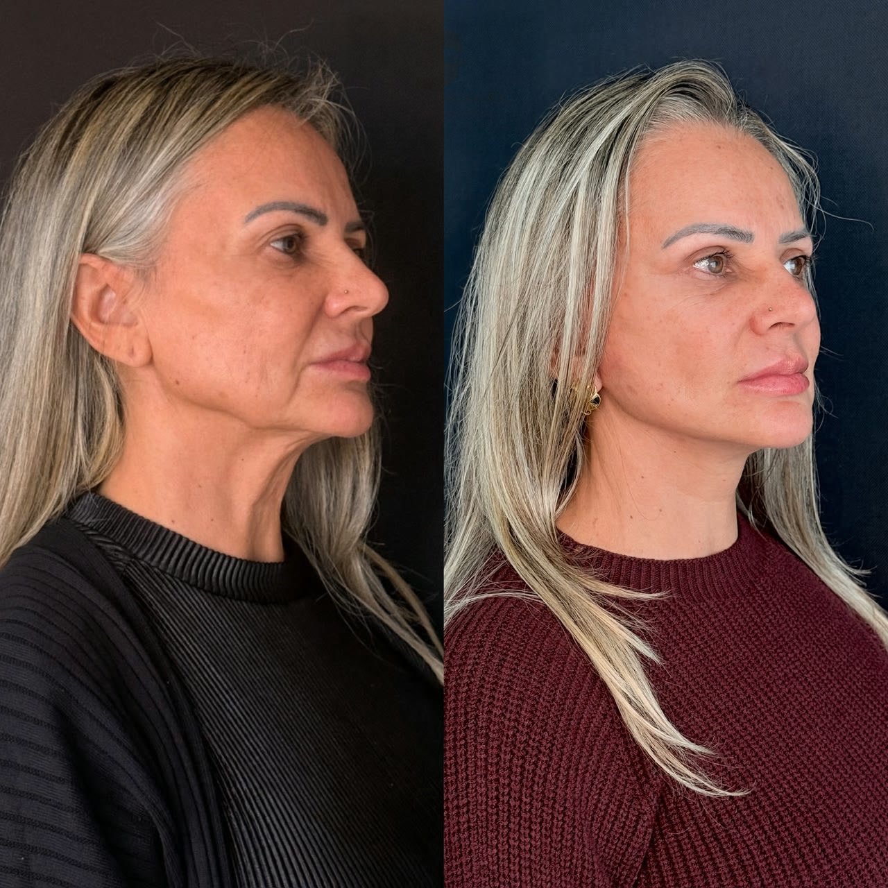 Comparativo de antes e depois de lifting facial, resultado 11